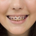 Effortless Ways To Save Up For Braces